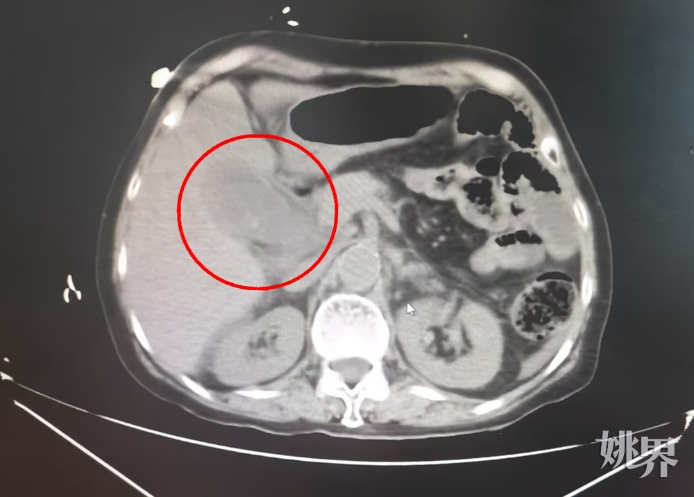 惊人!浙江女子体内密密麻麻塞满了…一度休克,这种疾病起初大多无症状