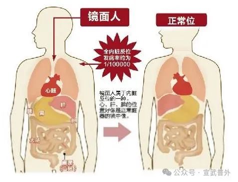 快去医院查查，你是“镜面人”吗？