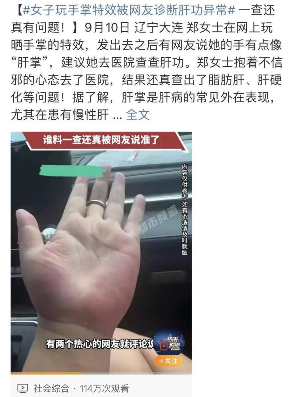 女子晒出手掌后被诊断出肝脏疾病，网络医生“立功”