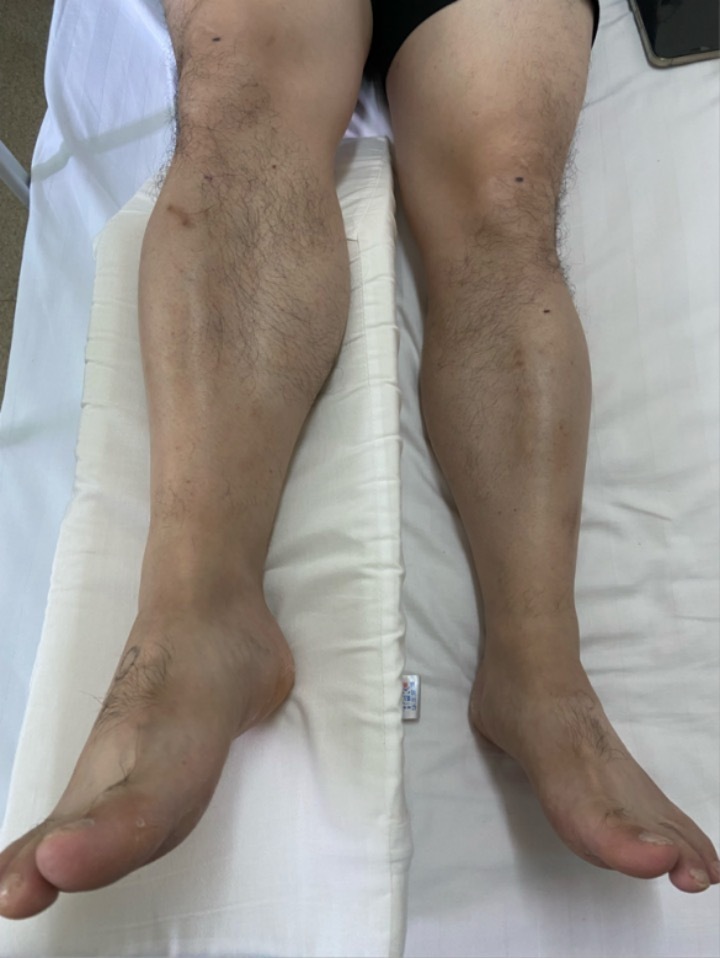 右腿疼痛浮肿，男子确诊静脉血栓！医生提醒：揉腿、拍打很危险