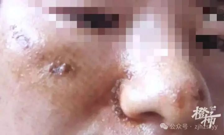 知名脱口秀演员自曝长“脸结石”？有人一个月没洗脸，长出了...