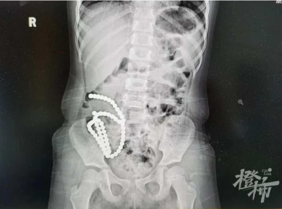 4岁男孩被撞后骨骼无碍，照CT发现两处穿孔！家长要注意了！