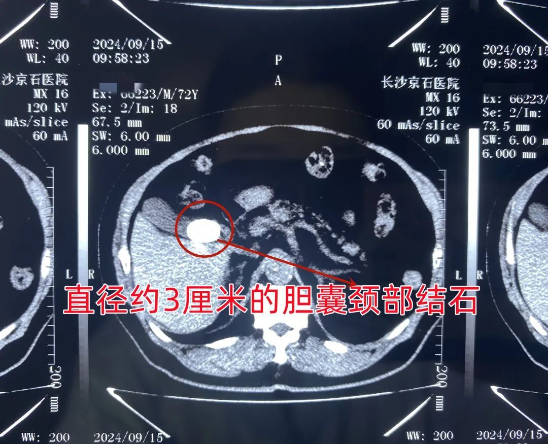 结石不痛就不管，72岁老人身体健康“亮红灯”