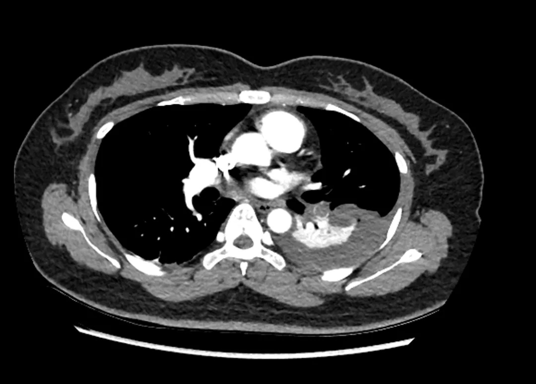 25岁姑娘服用避孕药致肺栓塞!专家提醒:出现这些症状要当心 25岁姑娘服用避孕药致肺栓塞!专家提醒:出现这些症状要当心