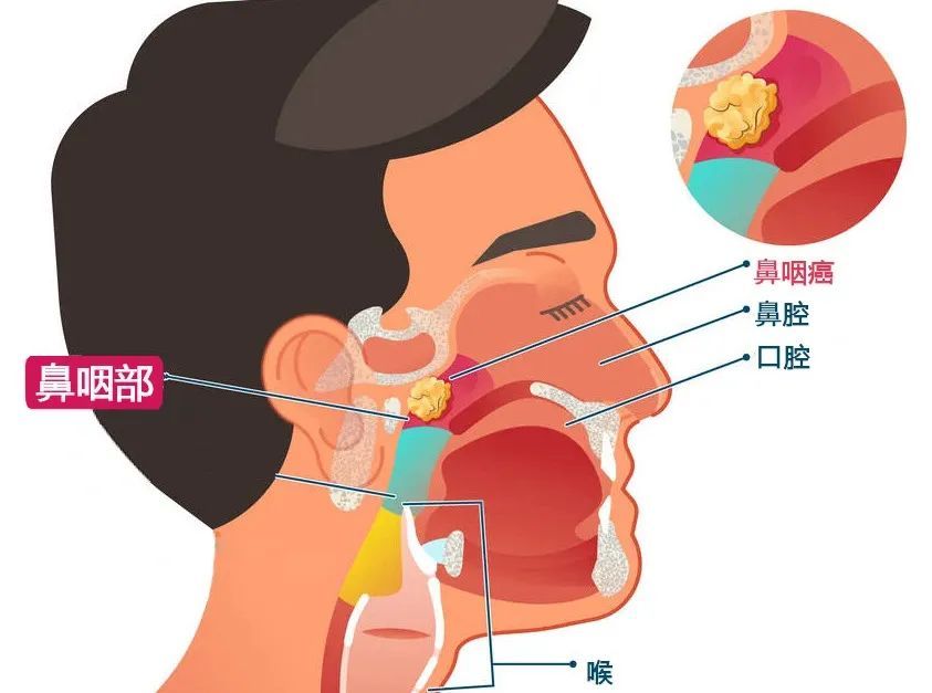 鼻塞、流鼻血？请警惕！！！！这种病50%发生在我国！