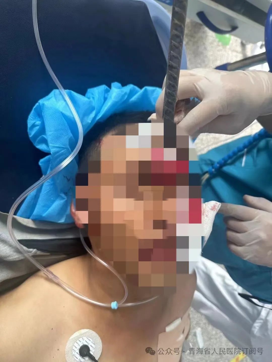 事发青海,1米长钢筋从鼻根穿入男子体内...... 事发青海,1米长钢筋从鼻根穿入男子体内......