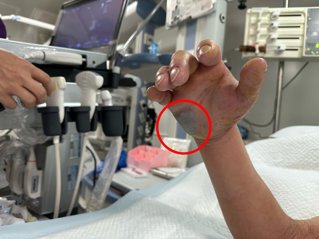 48小时内可致死!男子洗锅被钢丝球扎伤手,送进ICU才抢回一命…… 48小时内可致死!男子洗锅被钢丝球扎伤手,送进ICU才抢回一命……