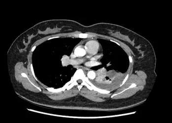 25岁姑娘服用避孕药致肺栓塞!专家提醒:出现这些症状要当心 25岁姑娘服用避孕药致肺栓塞!专家提醒:出现这些症状要当心