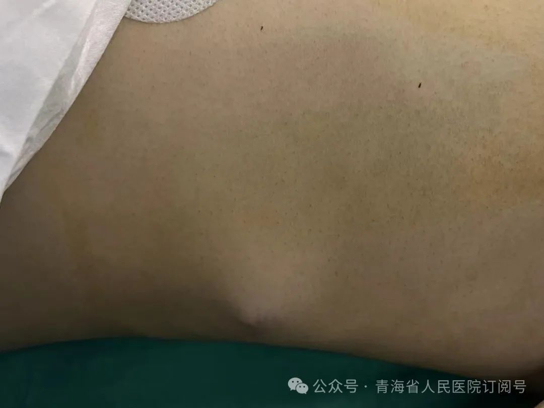 事发青海,1米长钢筋从鼻根穿入男子体内...... 事发青海,1米长钢筋从鼻根穿入男子体内......