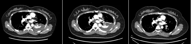 25岁姑娘服用避孕药致肺栓塞!专家提醒:出现这些症状要当心 25岁姑娘服用避孕药致肺栓塞!专家提醒:出现这些症状要当心