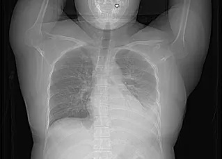 25岁姑娘服用避孕药致肺栓塞!专家提醒:出现这些症状要当心 25岁姑娘服用避孕药致肺栓塞!专家提醒:出现这些症状要当心