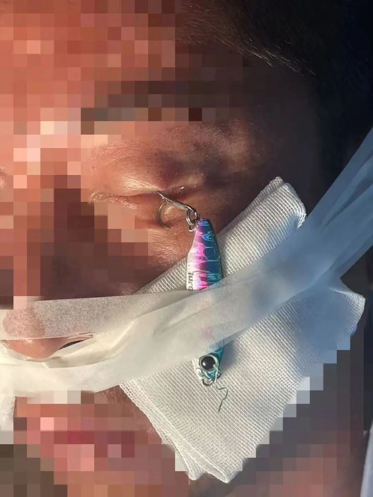 男子海钓时被鱼钩钩住眼睛，左眼眼睑被刺穿