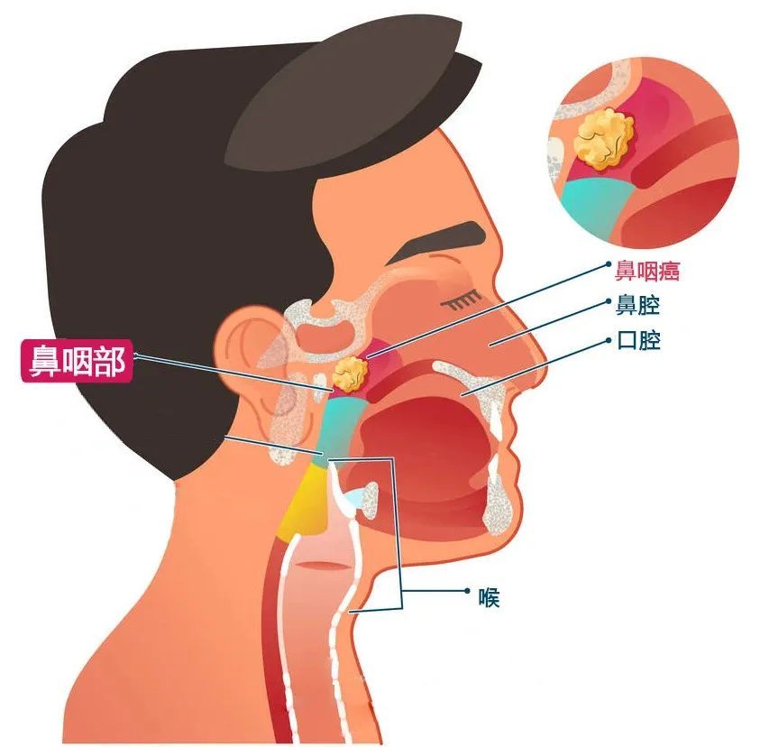 这种癌症，为何绕过北方人，直接盯上南方人...