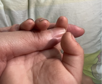 1岁女童被扎多个针眼！医生紧急提醒