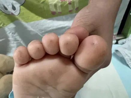 1岁女童被扎多个针眼！医生紧急提醒