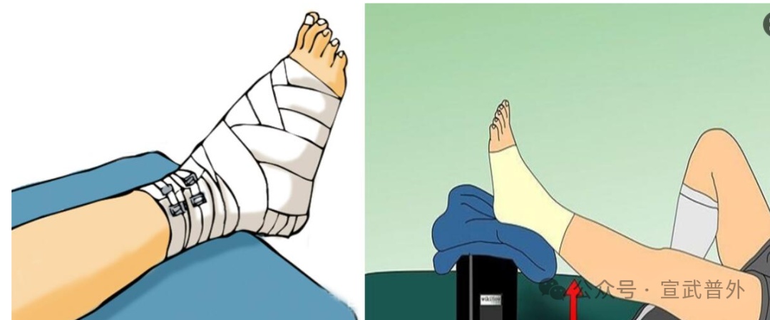 踝关节扭伤了，怎么办？