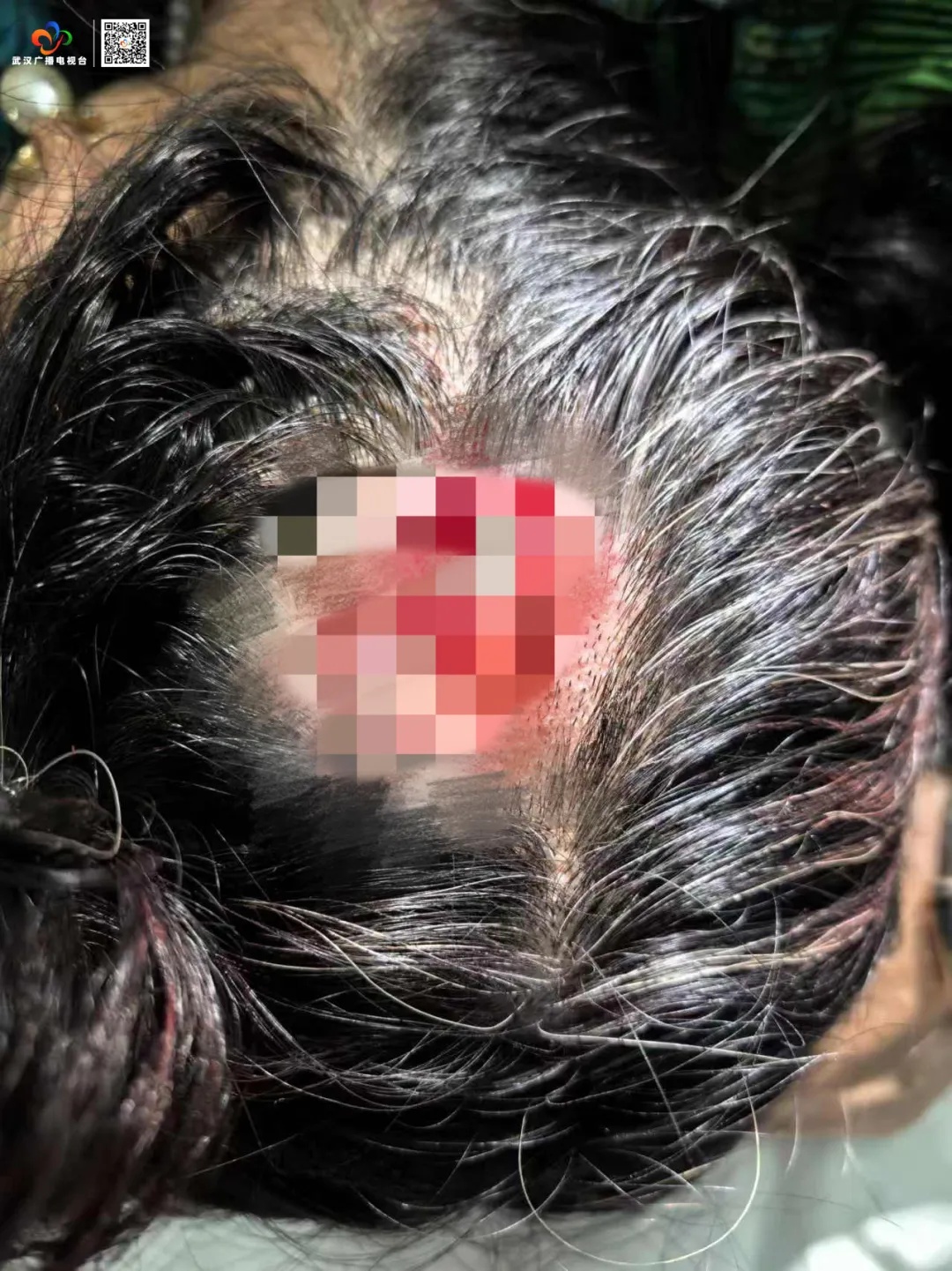 注意!这种发饰可致命!28岁女子摔倒后因它成植物人 注意!这种发饰可致命!28岁女子摔倒后因它成植物人