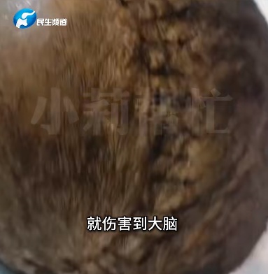 注意!这种发饰可致命!28岁女子摔倒后因它成植物人 注意!这种发饰可致命!28岁女子摔倒后因它成植物人