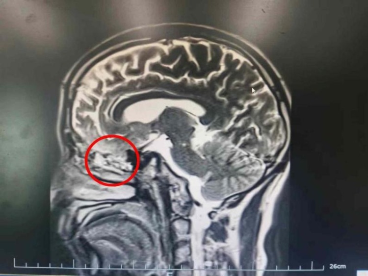 “清鼻涕”2个月流不停，竟是脑子漏水了！这种情况千万别忽视