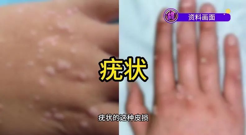 小心!女生做美甲竟感染HPV 医生提醒 小心!女生做美甲竟感染HPV 医生提醒
