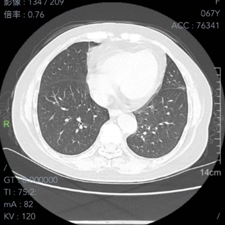 反复感染，胸闷气促一年治不好！根源竟是家中的它