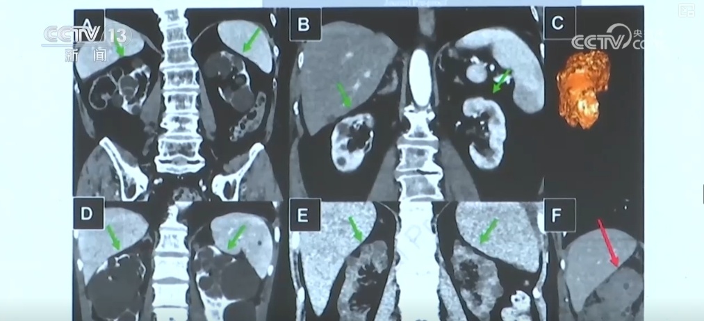 一系列支持政策落地见效,80余种纳入目录!为罕见病患者减负 一系列支持政策落地见效,80余种纳入目录!为罕见病患者减负