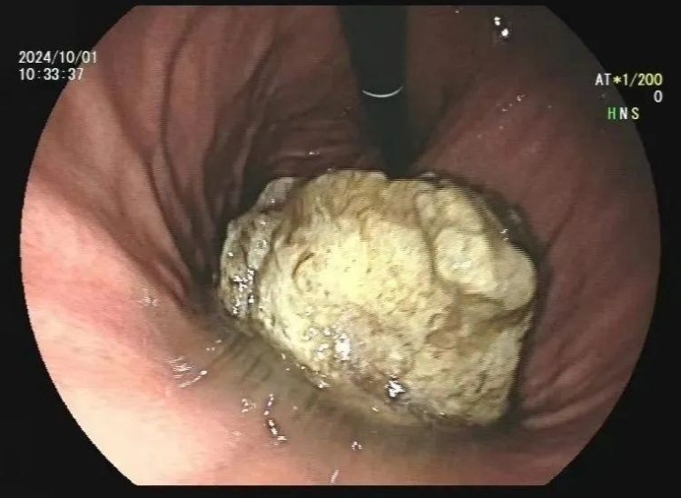 正大量上市!杭州小伙没忍住,直接吃进医院!年年都有,千万悠着点…… 正大量上市!杭州小伙没忍住,直接吃进医院!年年都有,千万悠着点……