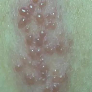 长这个是真的痛！女子拆快递后揉眼被确诊感染，超九成人体内潜伏