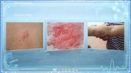 女子拆快递后揉眼睛确诊带状疱疹