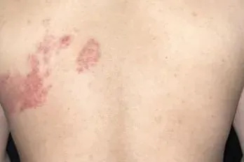 长这个是真的痛！女子拆快递后揉眼被确诊感染，超九成人体内潜伏