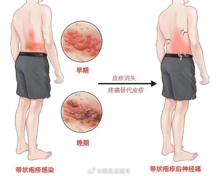 女子拆快递后揉眼睛确诊带状疱疹