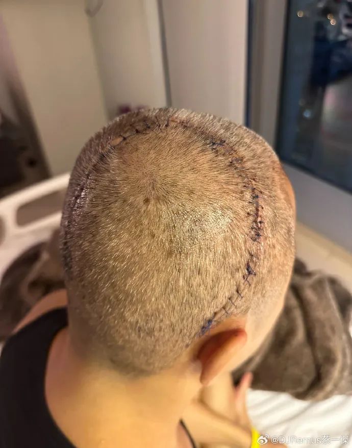 知名男歌手突然退出!自曝切除……网友:第一次见他剃光头 知名男歌手突然退出!自曝切除……网友:第一次见他剃光头