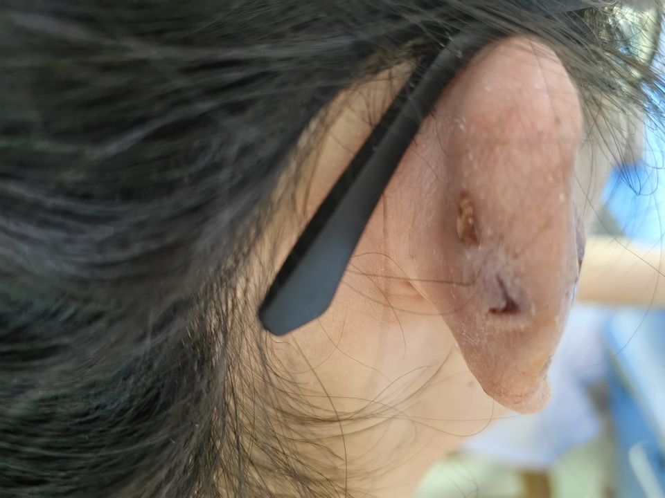 女大学生打耳骨钉后流脓血,就医发现软骨坏死、耳朵塌陷无法再生…… 女大学生打耳骨钉后流脓血,就医发现软骨坏死、耳朵塌陷无法再生……