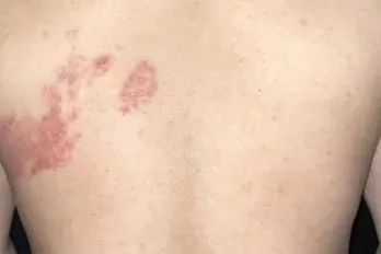 女子拆快递后确诊感染!疼痛难忍, 具有传染性…紧急提醒 女子拆快递后确诊感染!疼痛难忍, 具有传染性…紧急提醒