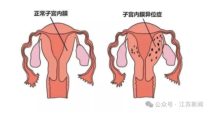 小心痛经背后的“恶魔”——子宫内膜异位症! 小心痛经背后的“恶魔”——子宫内膜异位症!