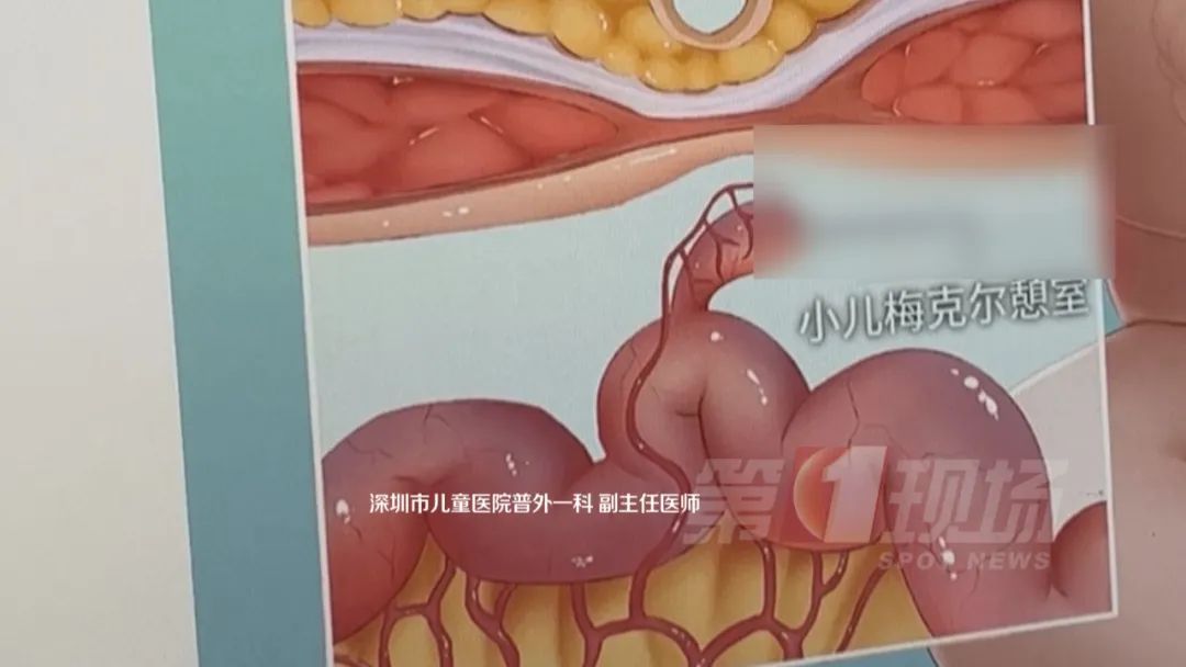 鱼刺卡喉,肠子被切3厘米?这个危险“土方”很多人在用...... 鱼刺卡喉,肠子被切3厘米?这个危险“土方”很多人在用......