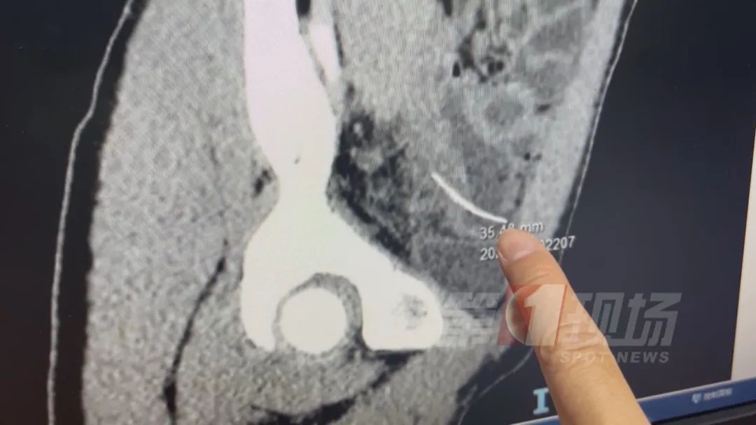 鱼刺卡喉,肠子被切3厘米?这个危险“土方”很多人在用...... 鱼刺卡喉,肠子被切3厘米?这个危险“土方”很多人在用......