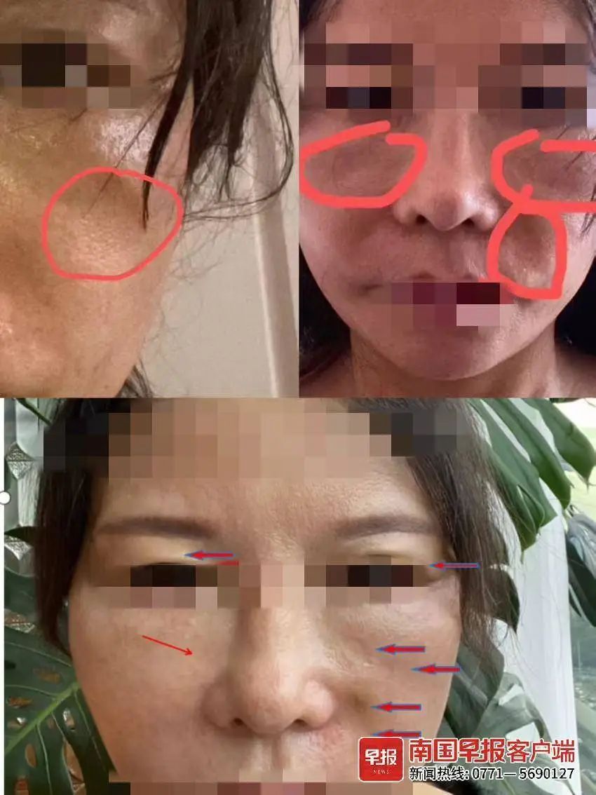 女子称花2.5万元打针，脸上出现凹坑！法院已立案受理