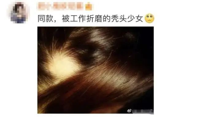 女演员张馨予自曝：斑秃了，“就很突然…”