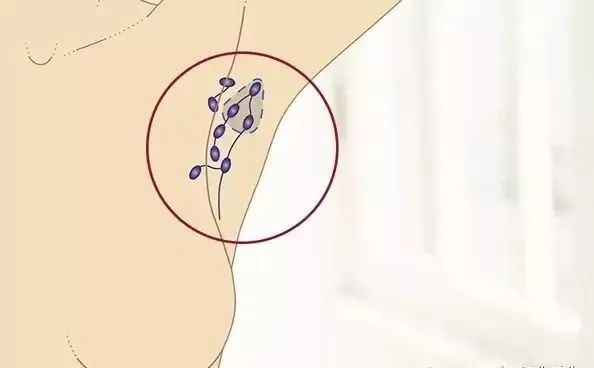 腋下的疙瘩是什么？