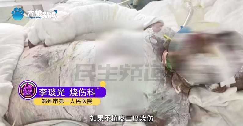 全身烧伤98%！18岁女儿第一个站了出来......