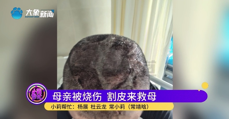 全身烧伤98%！18岁女儿第一个站了出来......