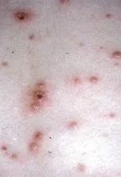 拆快递揉眼睛被感染？医生这样说