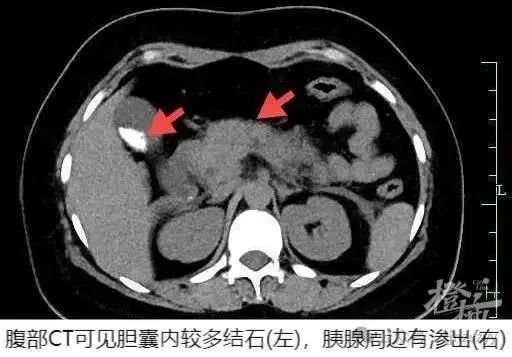 一口气干掉4只,她被连夜抢救!医生:餐桌上有这道菜的注意了 一口气干掉4只,她被连夜抢救!医生:餐桌上有这道菜的注意了