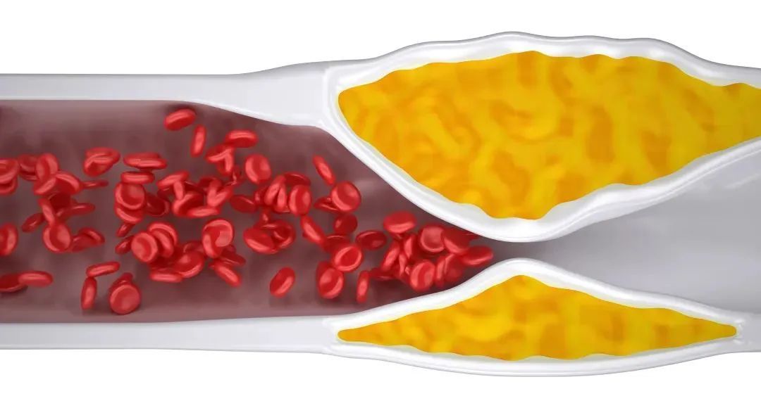 世界卒中日丨可怕的“中风”，知晓预防时间窗，降低风险！