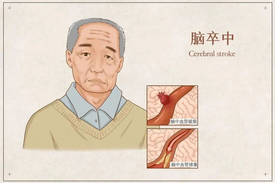世界卒中日丨可怕的“中风”，知晓预防时间窗，降低风险！