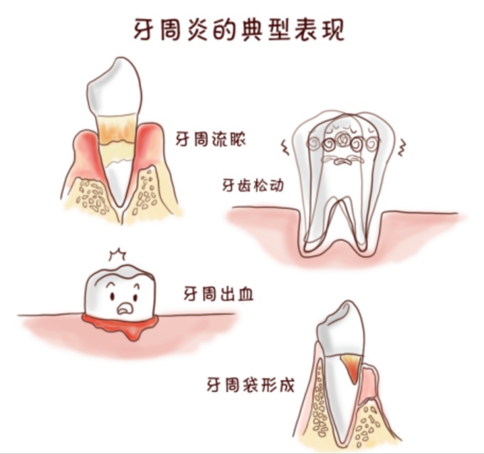 牙周炎会让牙齿都掉光吗？