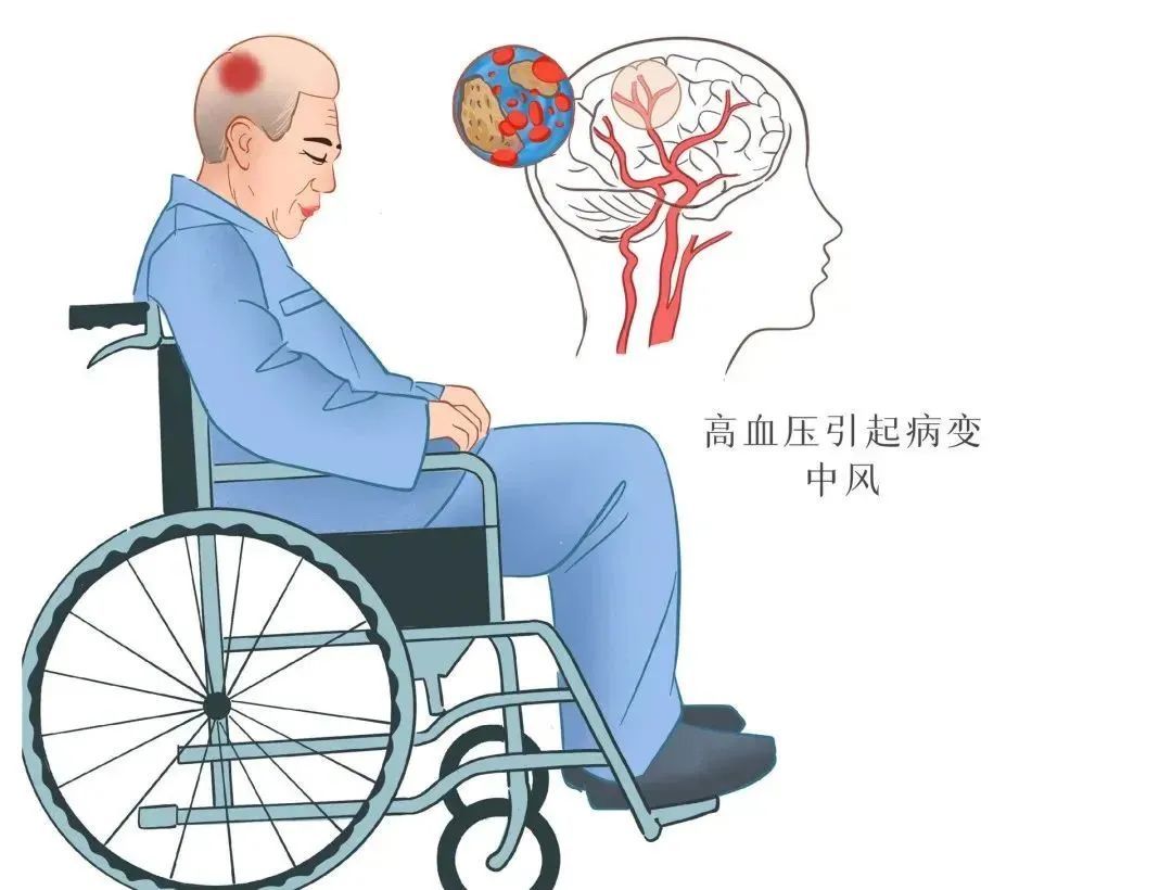 世界卒中日丨可怕的“中风”，知晓预防时间窗，降低风险！