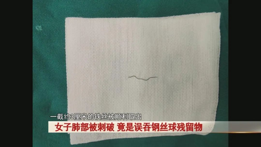 女子肺部被刺破,竟是误吞钢丝球残留物 女子肺部被刺破,竟是误吞钢丝球残留物