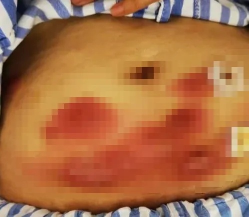 “你太胖了吧！”25岁女子全身感染！一掀肚子令人崩溃...